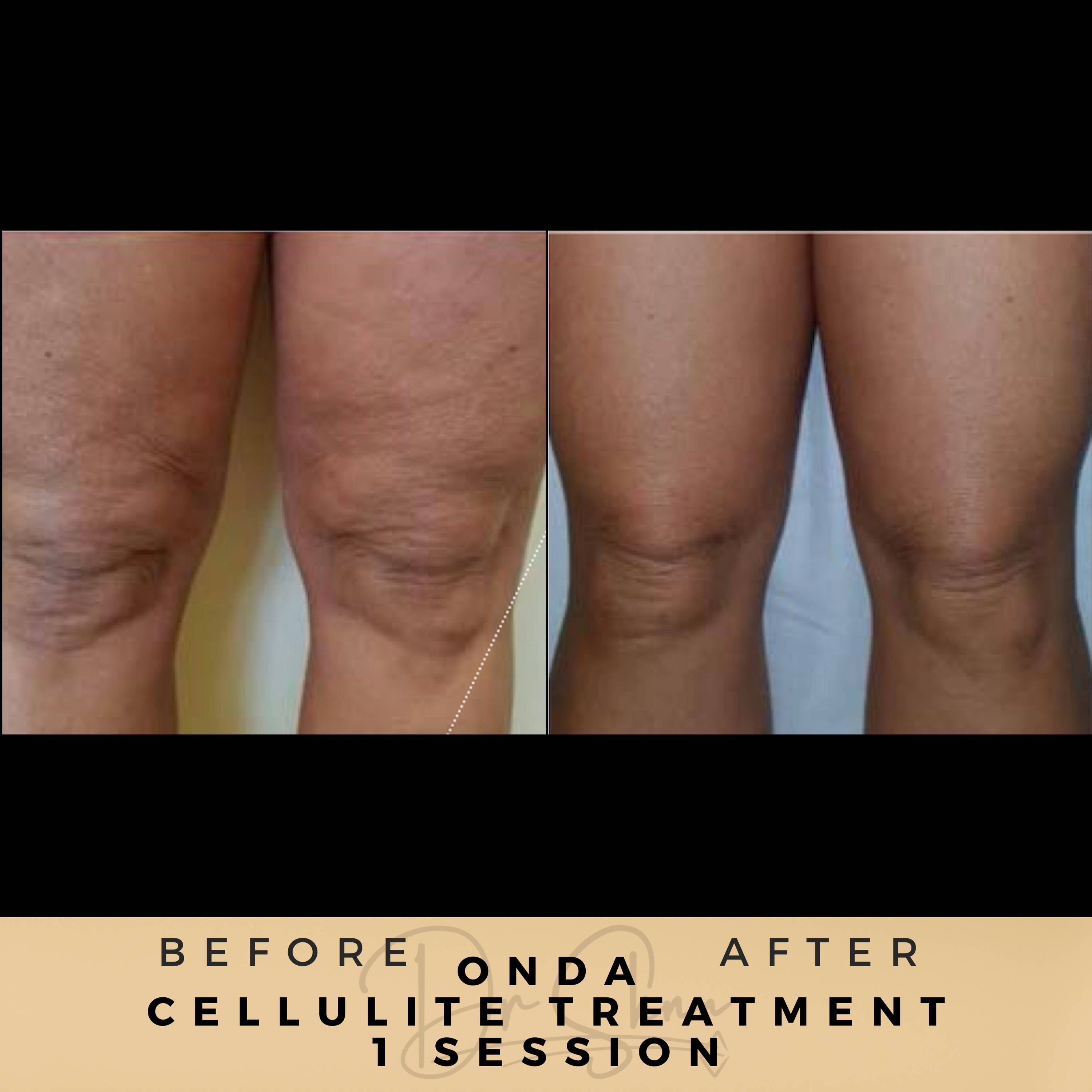 Cellulite Removal - Non-surgical - Dr Sknn before and after