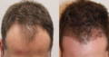 Hair Growth Essence before and after