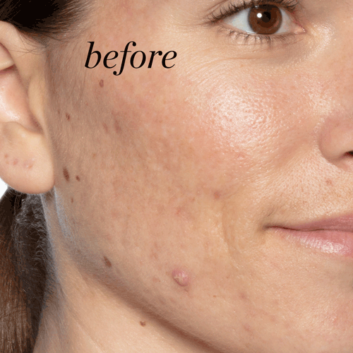 woman with skin texture and acne before and after