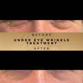 Personalised Eye Serum Skincare Dr Sknn Before & After Picture