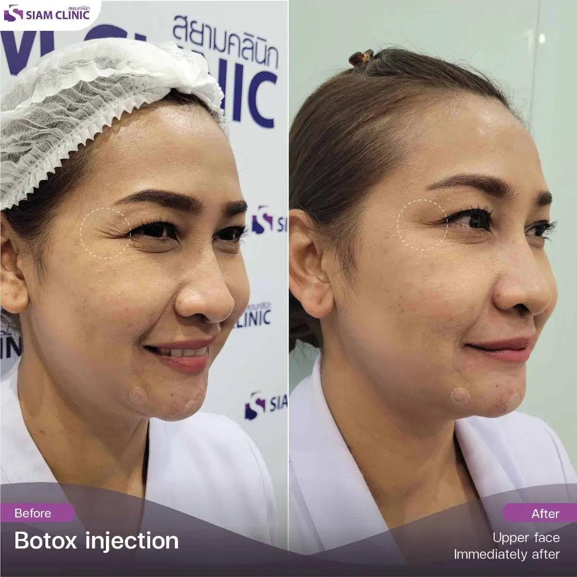 Wrinkle Botox treatment