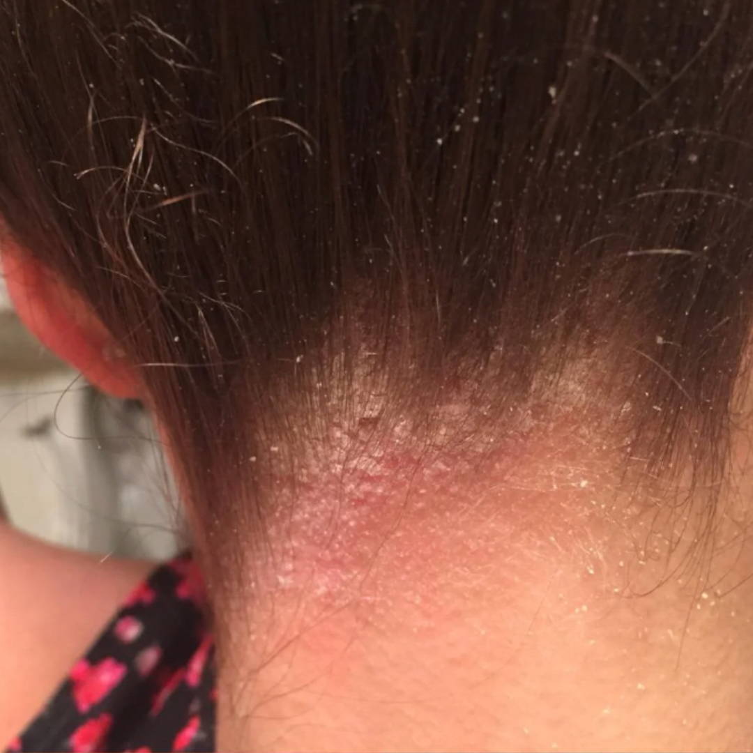 Scalp Psoriasis Treatment Learn How This Psoriasis Treatment Helped M
