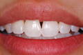 Anterior restoration: before the Bioclear Method