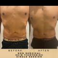 Before & After Pictures Dr Sknn Wilmslow Cheshire