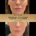 Cheek Fillers Wilmslow