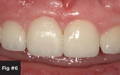 Final restoration with composite blended into the porcelain veneer.