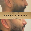 Nasal Tip Anti-Wrinkle Injections Wilmslow Before & After Dr Sknn