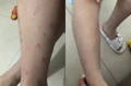  before and after natural remedy for psoriasis