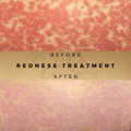 Redness Treatment Wilmslow Dr Sknn Before & After Picture