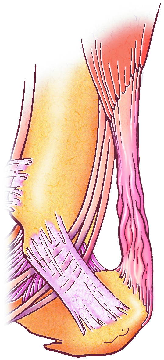 ACHILLES TENDINITIS ILLUSTRATION