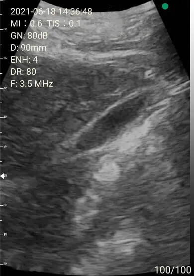 EagleView portable ultrasound image-gall bladder