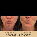 Perioral Line Fillers Wilmslow Before & After