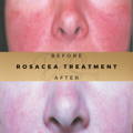 Rosacea Treatment Wilmslow Dr Sknn Before & After Picture
