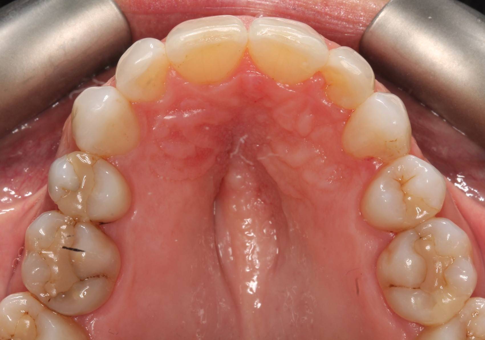 Post-operative maxillary occlusal view 