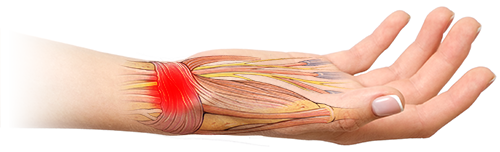 MODERATE & SEVERE SPRAINS ILLUSTRATION