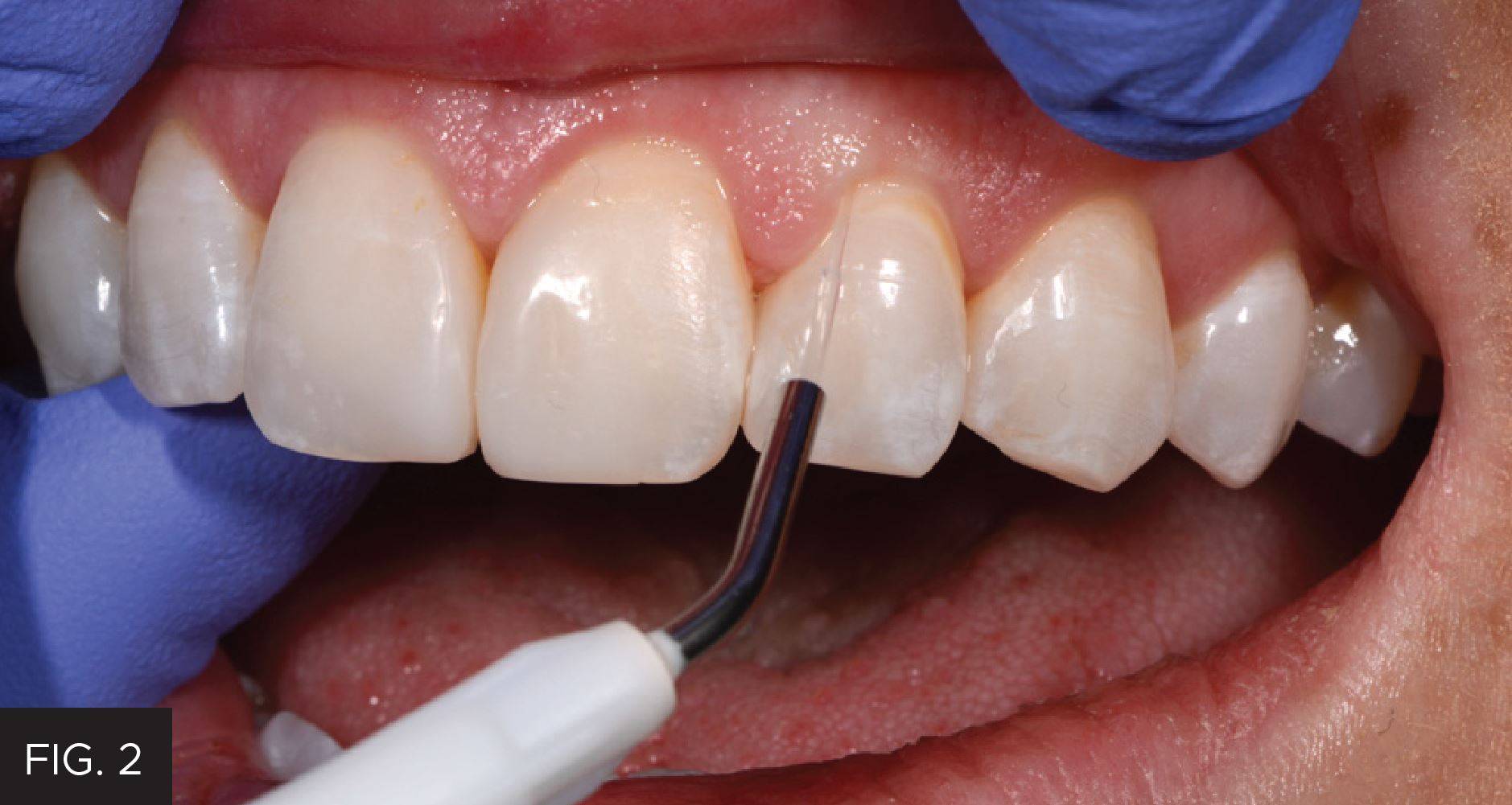 Gingival Sculpting With a Soft Tissue Diode Laser: Figure 2