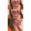 Dermal Fillers - Lip Fillers - Before