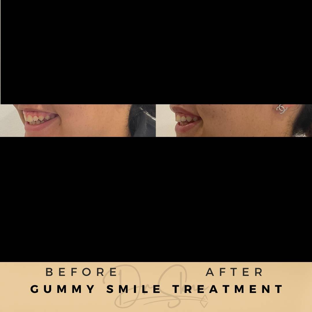 Gummy Smile Treatment Wilmslow Before & After Dr Sknn