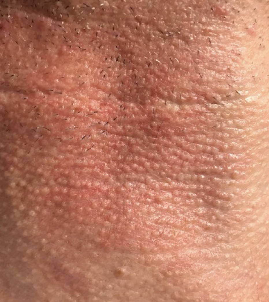 Intense Pulsed Light Pigmentation Removal After