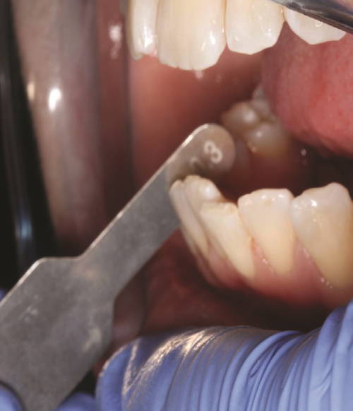 meaduring the reduced interproximal space