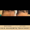 Hair Loss Treatment Dr Sknn Before & After Picture