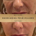 Nasolabial Fold Fillers Wilmslow
