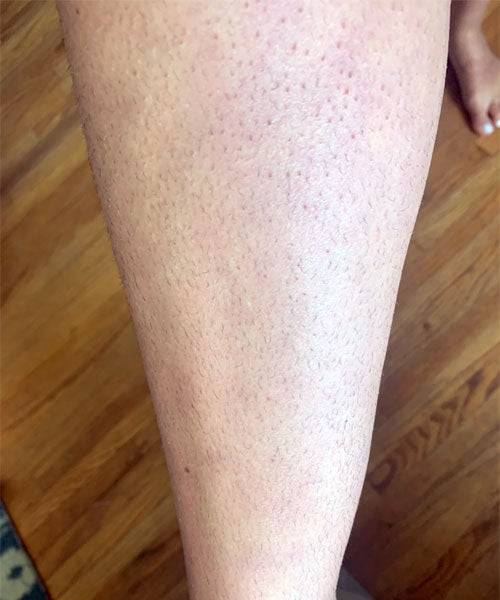 Rosacare Ipl Beauty & Health