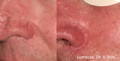 Nose with visible veins before and after Lumecca IPL