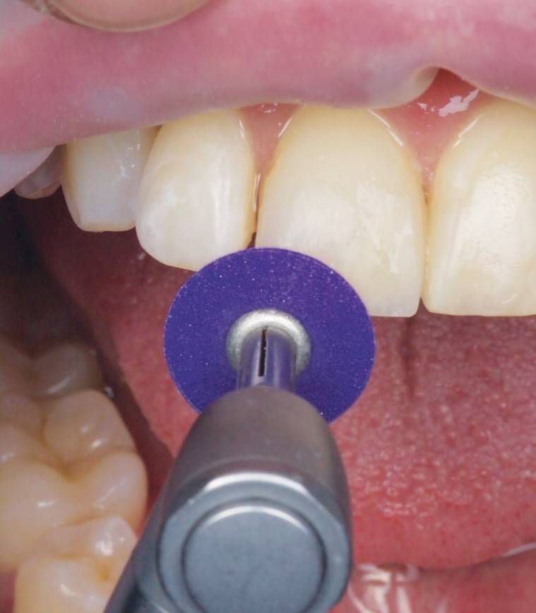 Purple coarse polishing disc approaching upper tooth getting restored