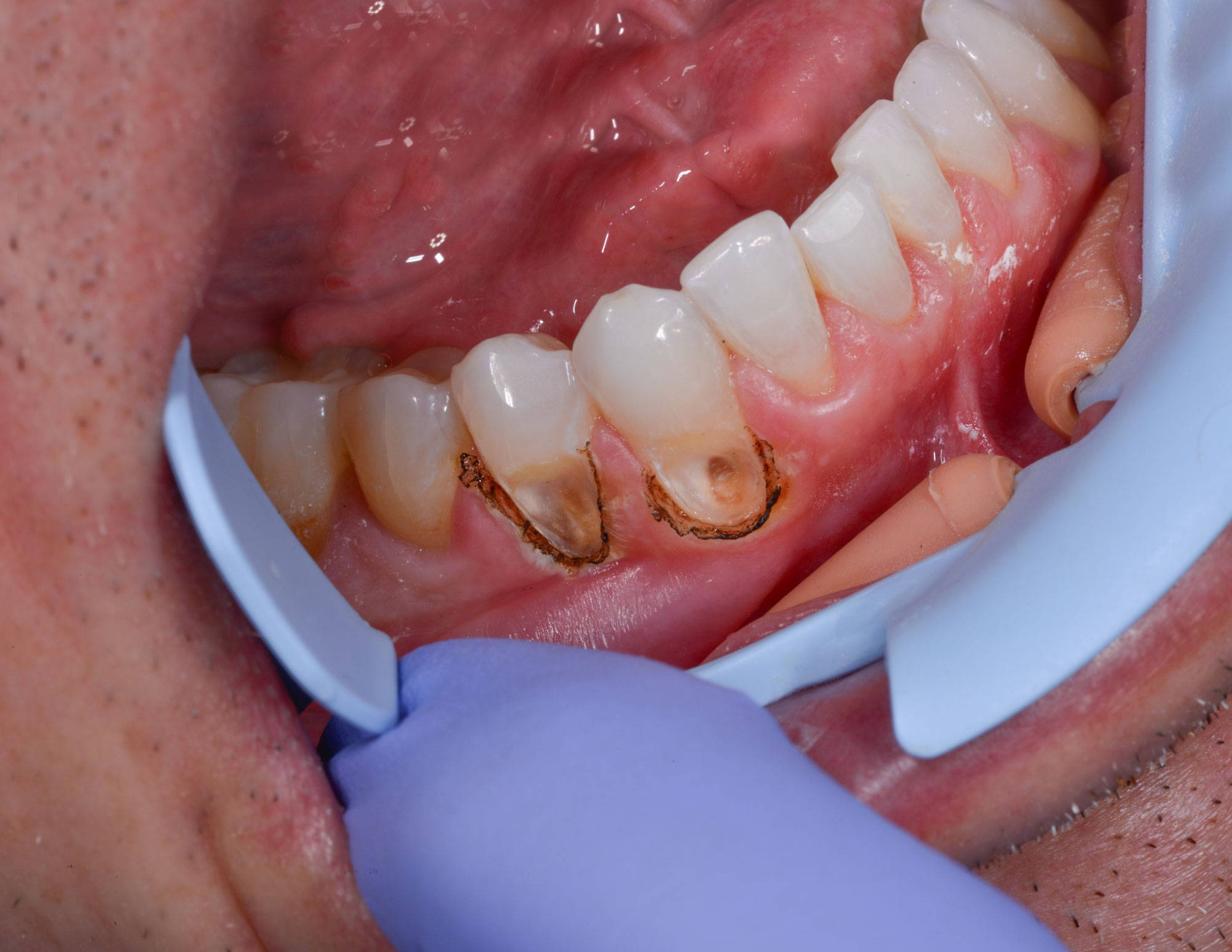 Subgingival decay exposed with burnt gums around it