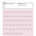 view the ECG waveform and get the ECG report