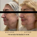 Cheek Fillers Wilmslow