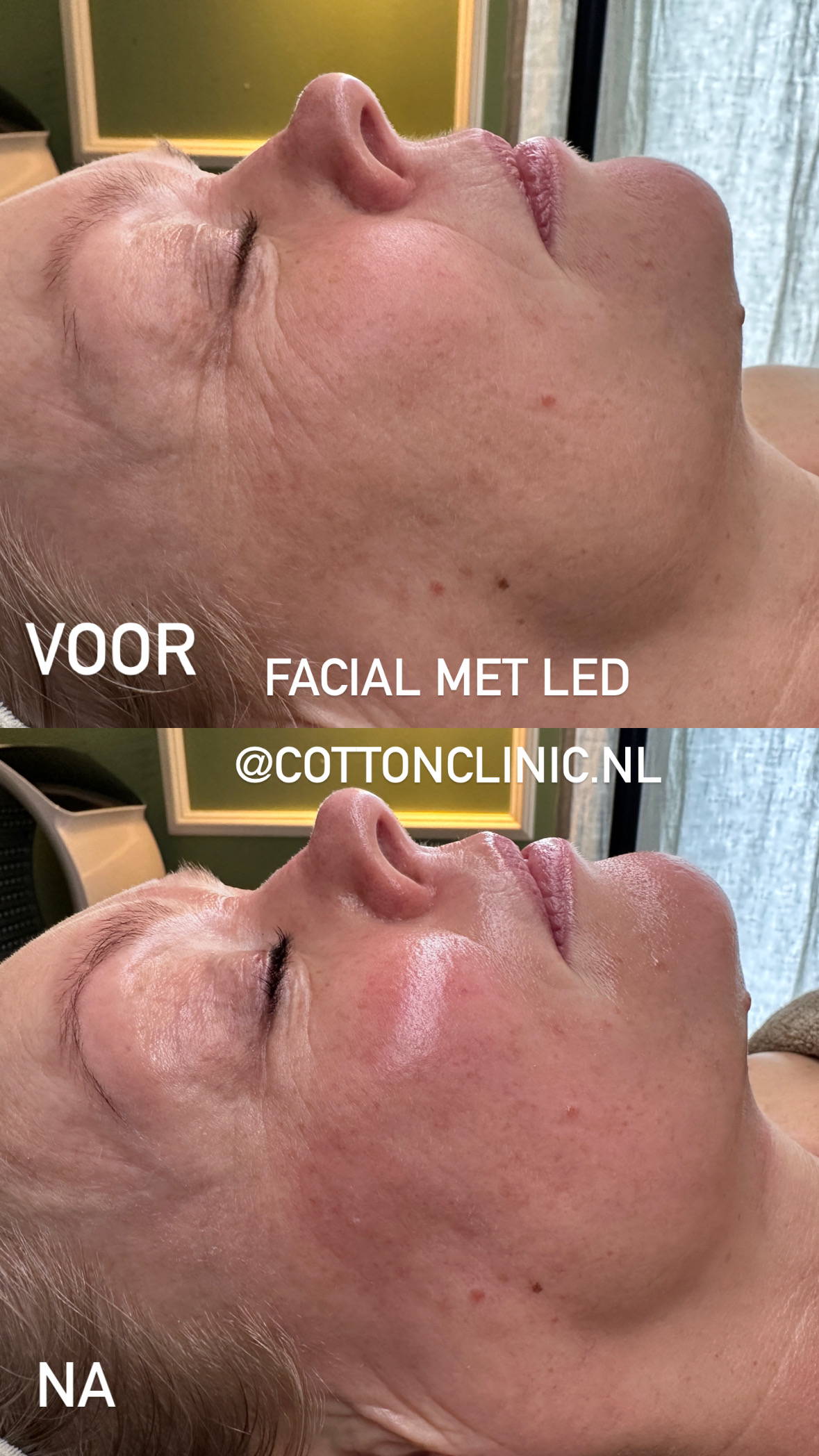 voor en na foto van ledtherapie Cotton Clinic zaandam, facial in combinatie met ledtherapie