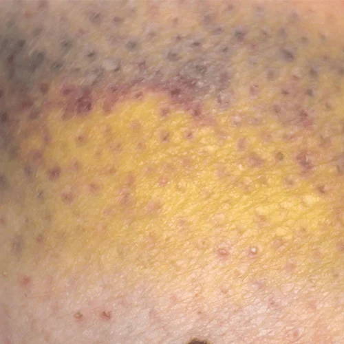 Bruise healing progress after three treatments with a laser pain relief device