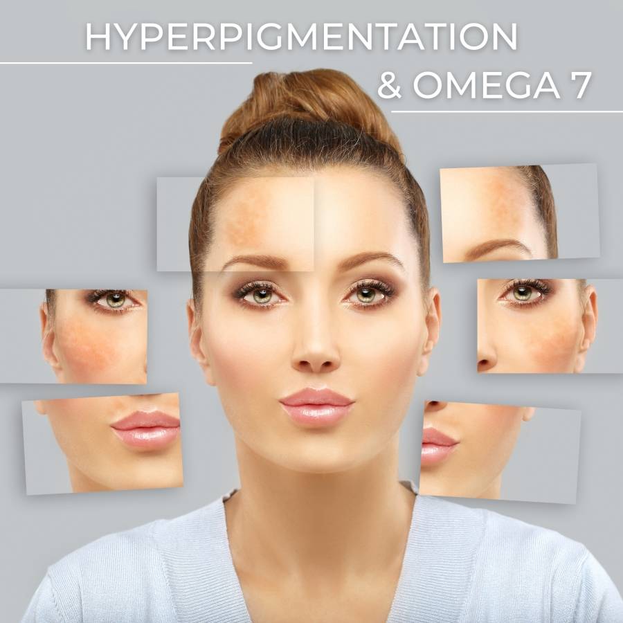 hyperpigmentation and omega 7 benefits