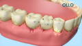 3D illustration of a unhealthy oral health condition, suffering gum disease, breeding gums and bad breath