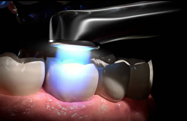 Curing light curing tooth