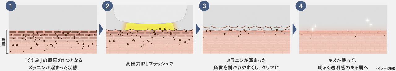 IPL技術