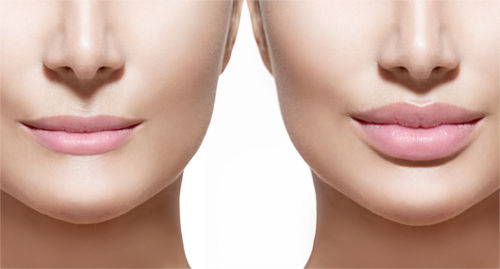 Before and after Luma Lips