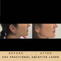 Pigmentation Treatment Co2 Fractional Laser Wilmslow Dr Sknn Before & After Picture