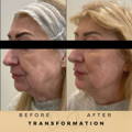 Jowl Fillers Wilmslow Dr Sknn Before & After Picture