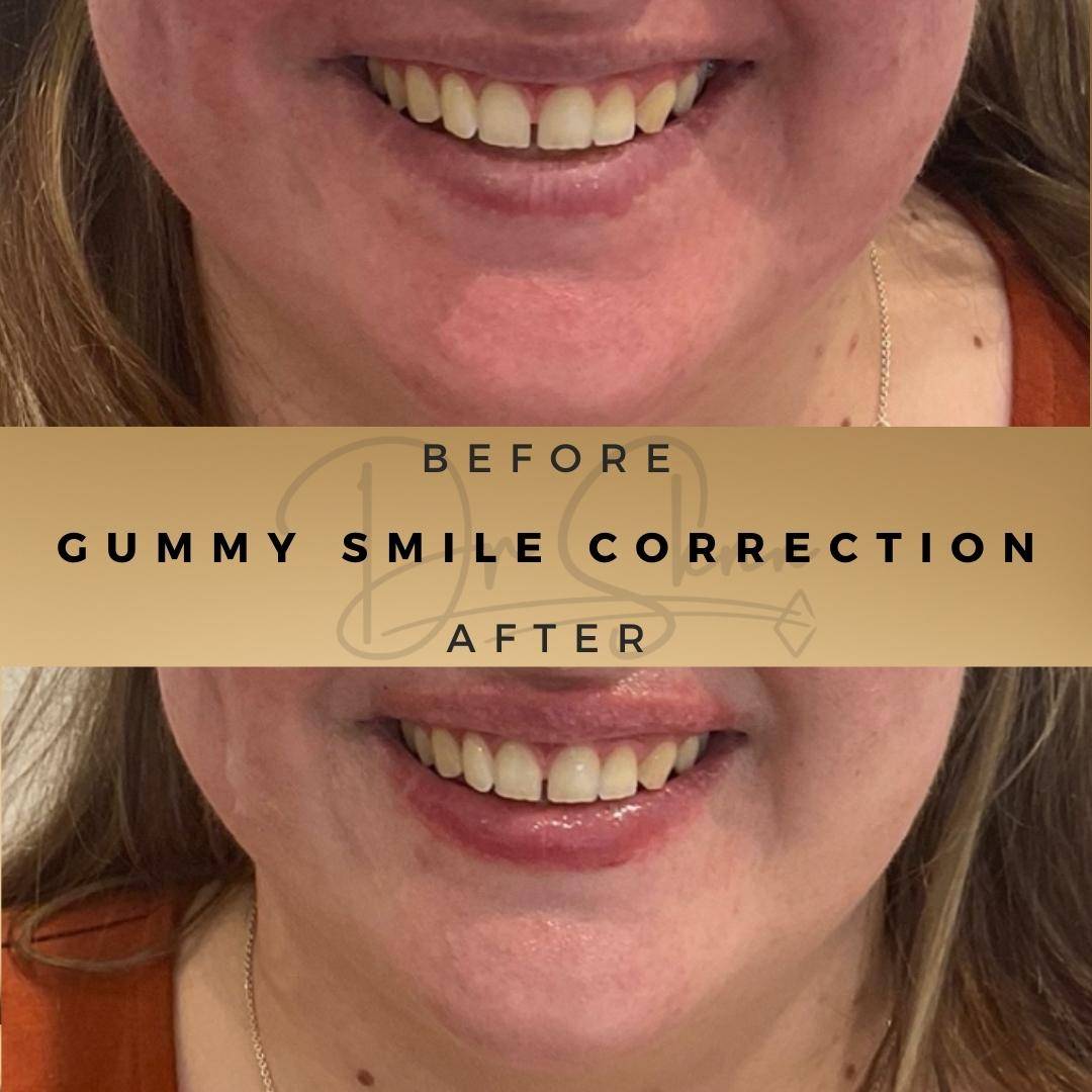 Gummy Smile Treatment Wilmslow Before & After Dr Sknn