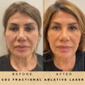Skin Rejuvenation Before & After Dr Sknn