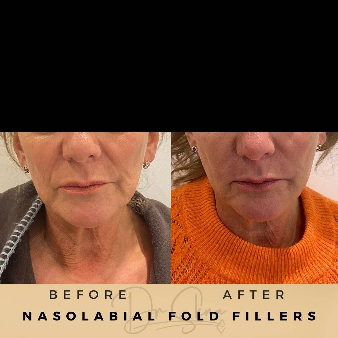 Nasolabial Fold Fillers - Dr Sknn before and after