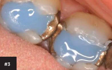 Cosmecore is used on the tooth