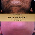 Laser Hair Removal Wilmslow Dr Sknn Before & After Picture