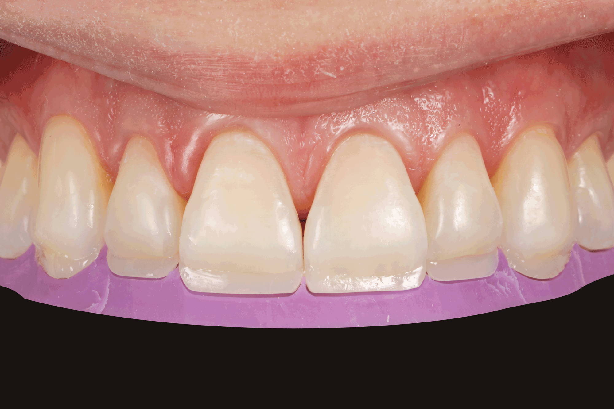 upper teeth in tray