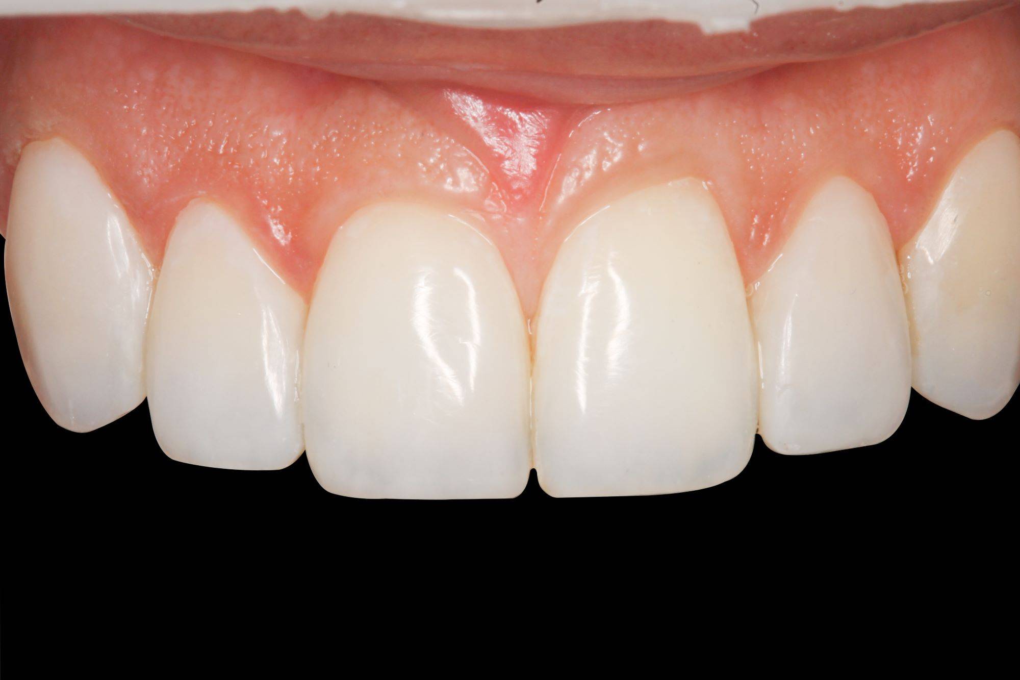 upper teeth after restoration in black background