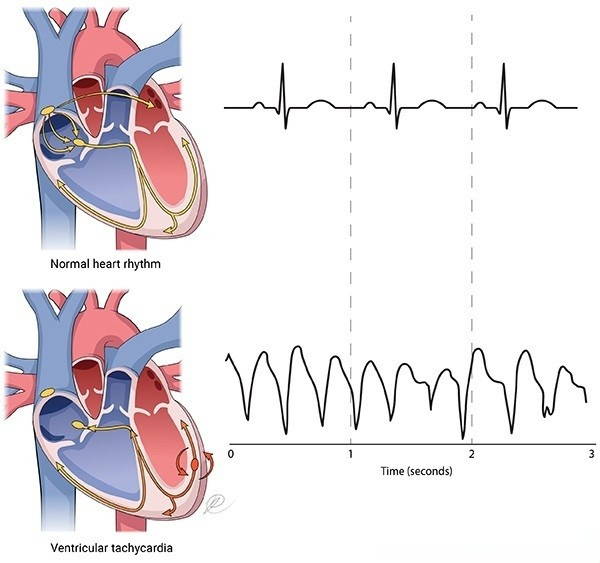 taquicardia ventricular