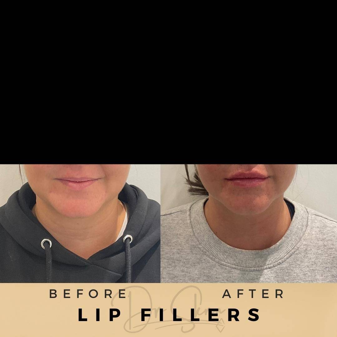 lip fillers